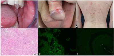 Case report: Detection of anti-bullous pemphigoid antigen 180 antibodies in a patient with Behçet’s disease